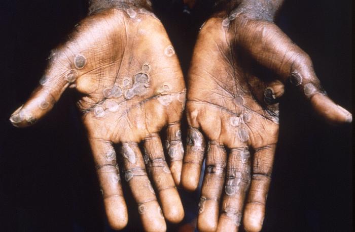 This 1997 image was created during an investigation into an outbreak of monkeypox, which took place in the Democratic Republic of the Congo (DRC), formerly Zaire, and depicts the palms of a monkeypox case patient from Lodja, a city located within the Katako-Kombe Health Zone, of the DRC. It is important to note, how similar this maculopapular rash appears to be when compared to the rash of smallpox, also an Orthopoxvirus.